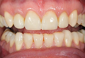 Teeth Whitening in Ocean Township