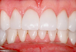 Ocean Township Before and After Dental Fillings