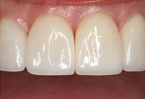 07712 Before and After Invisible Braces