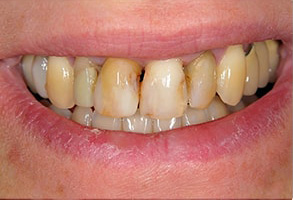 Ocean Township Dental Implants