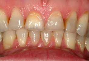 Before and After Dental Fillings in Ocean Township