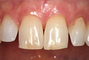 07712 Before and After Dental Bleaching